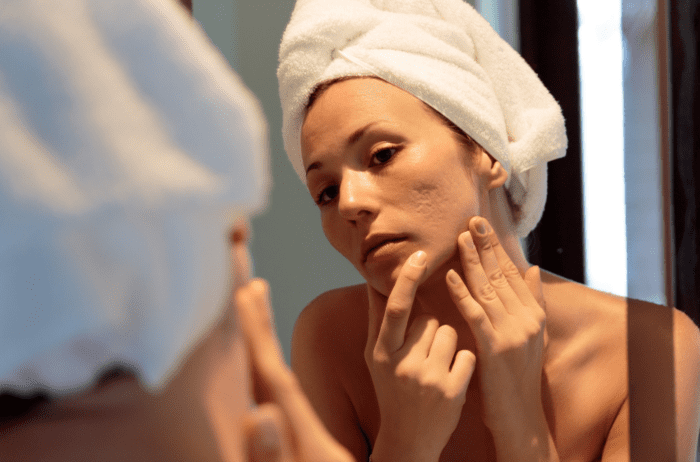 image de l'article Comment atténuer l’acné due à la grossesse ?