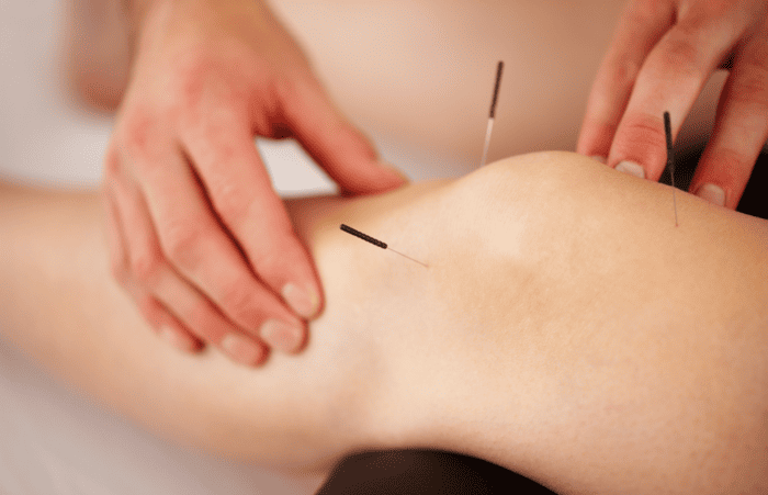 image de l'article Comment l'acupuncture peut aider pendant le post partum ?