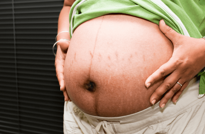 image de l'article Comment prévenir les vergetures pendant la grossesse ?