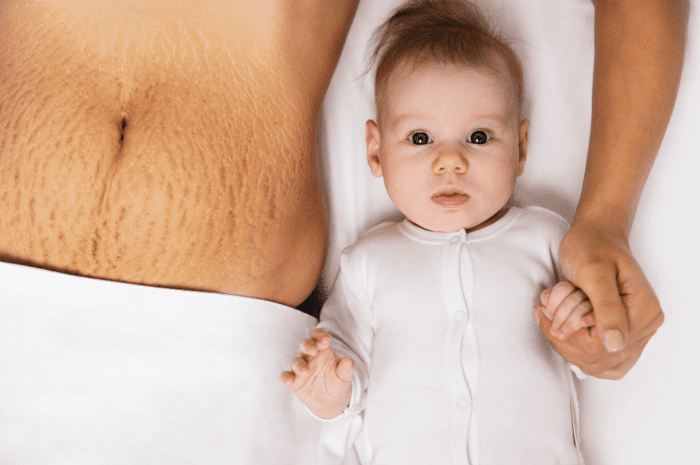 image de l'article Post-partum : fabriquer soi-même une crème anti-vergetures avec des ingrédients naturels